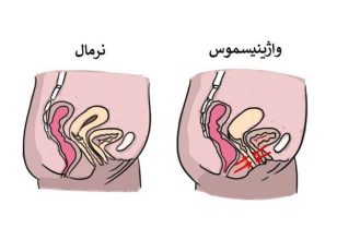 🧠 واژینیسموس: وقتی بدن می‌گوید نه، حتی اگر ذهن بگوید آره نویسنده: دکتر طاهره یارمحمدی | دکترای روانشناسی و درمانگر روابط زوجین و جنسی