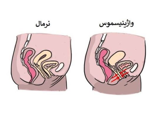 🧠 واژینیسموس: وقتی بدن می‌گوید نه، حتی اگر ذهن بگوید آره نویسنده: دکتر طاهره یارمحمدی | دکترای روانشناسی و درمانگر روابط زوجین و جنسی