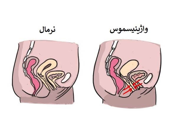 🧠 واژینیسموس: وقتی بدن میگوید نه، حتی اگر ذهن بگوید آره نویسنده: دکتر طاهره یارمحمدی | دکترای روانشناسی و درمانگر روابط زوجین و جنسی